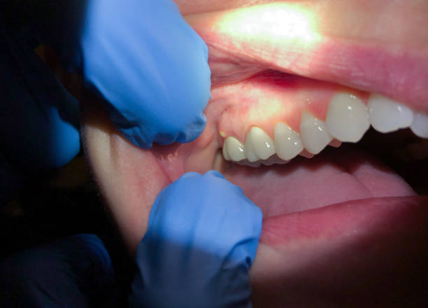 Best Emergency Dental Care for Abscessed Tooth in Perkasie, PA